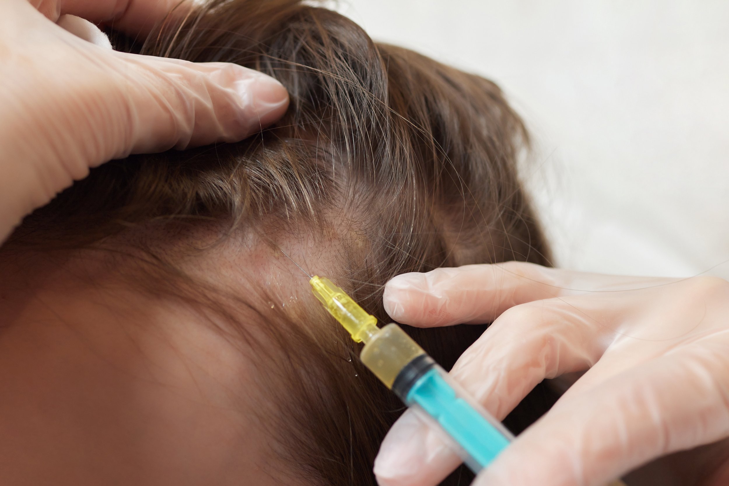 Close-up of a person receiving an injection in the scalp with a syringe, while wearing gloves.