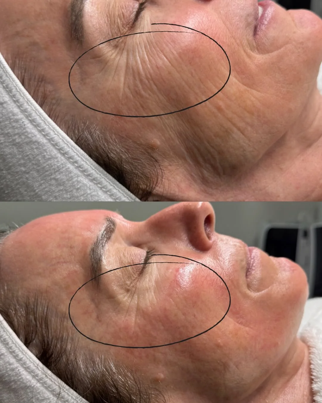 Can we talk about the results after just one Ultimate Glow Facial? The facial protocol I did here was the @circadia Beyond Botox protocol, and the results are incredible. Treatment includes dermaplaning, lactic acid no downtime peel, and a firming pe
