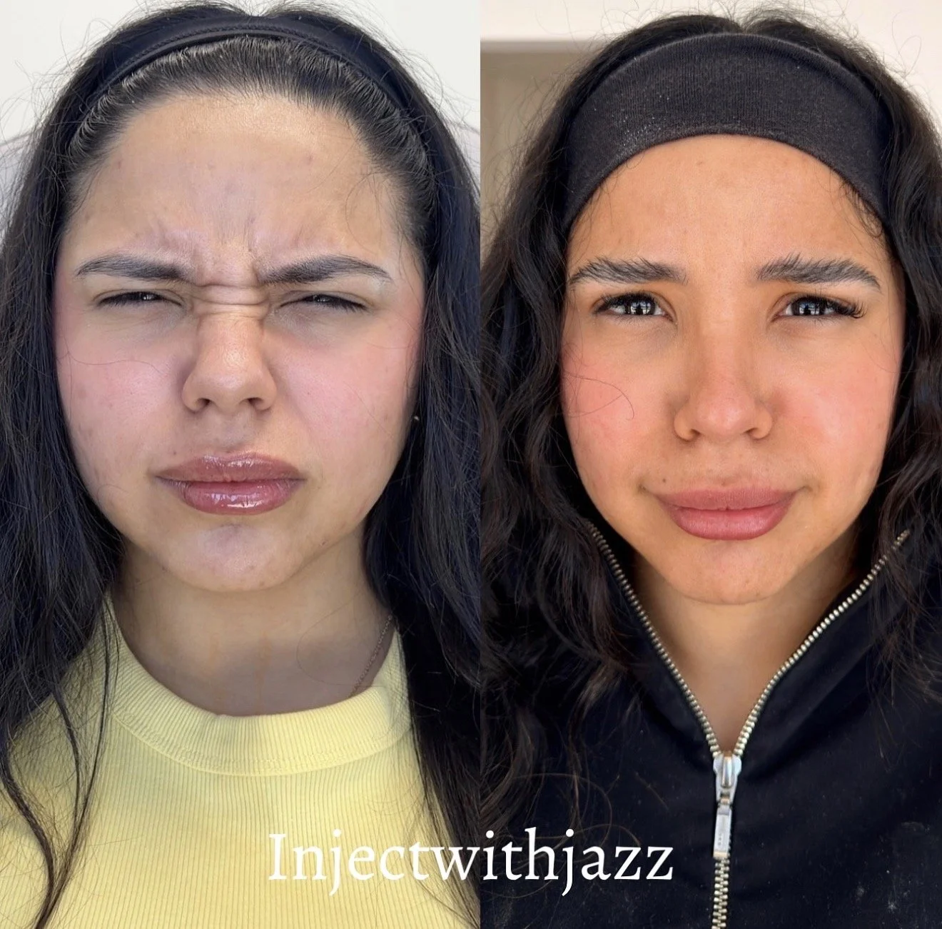 Injector: Jazmin Rivero          Treated Areas: Bunnies 