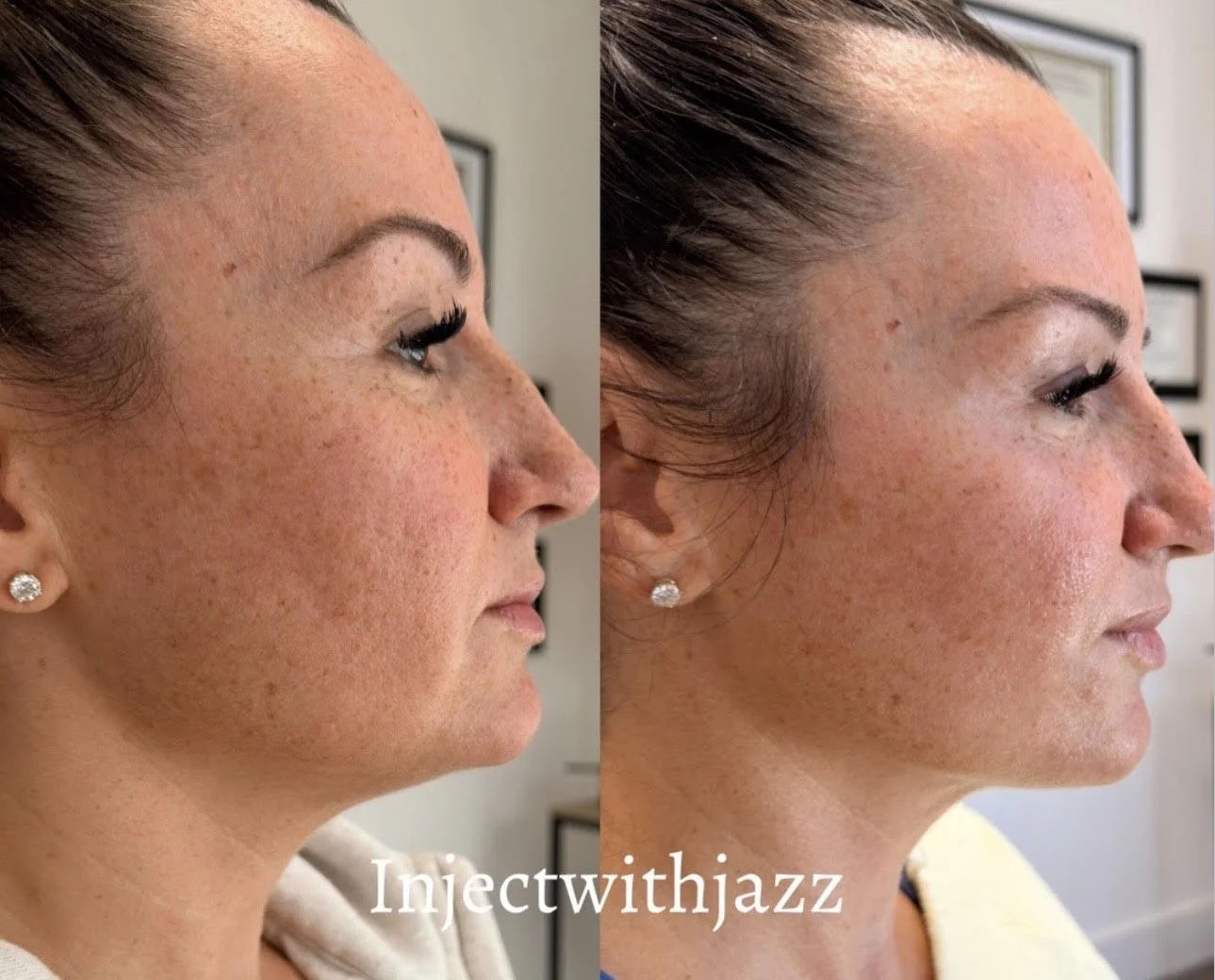 Injector: Jazmin Rivero PA-C     Treated area/s: Nefertiti & Dao 