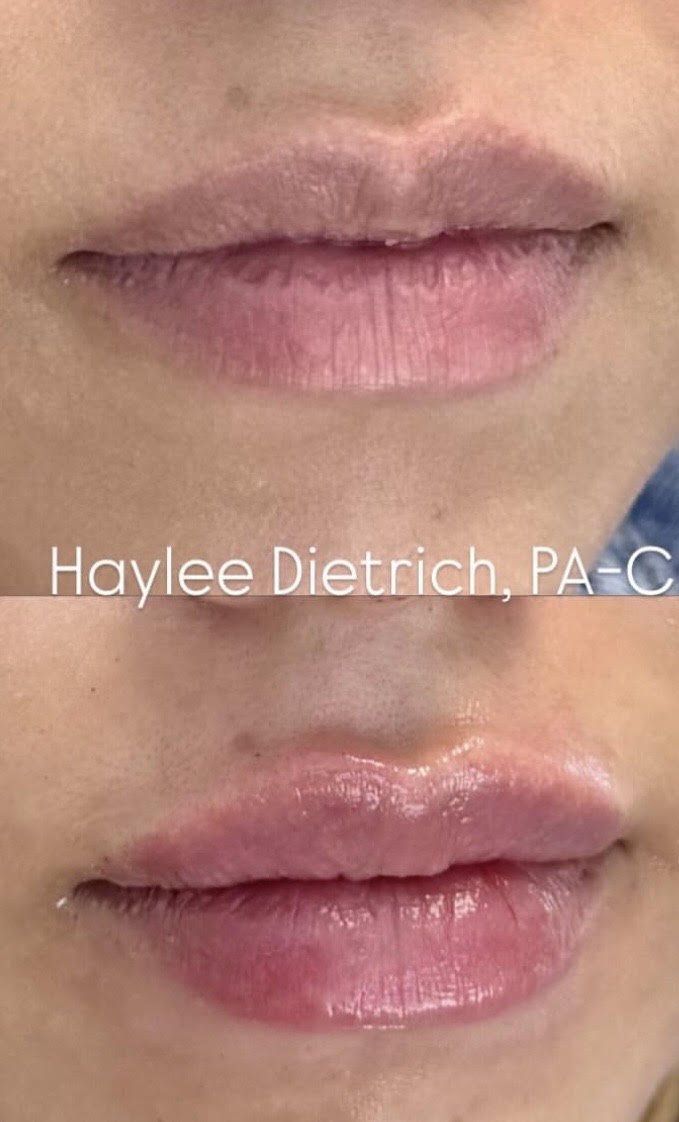 Injector: Haylee Dietrich PA-C   Area Treated: Lips 