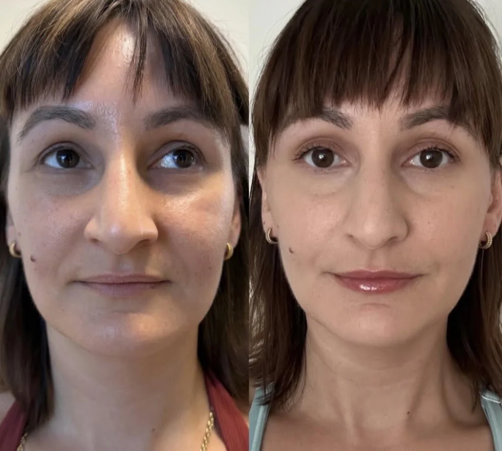 Injector: Ada Bello APRN    Areas Treated: Nasolabial, under eyes, lips 
