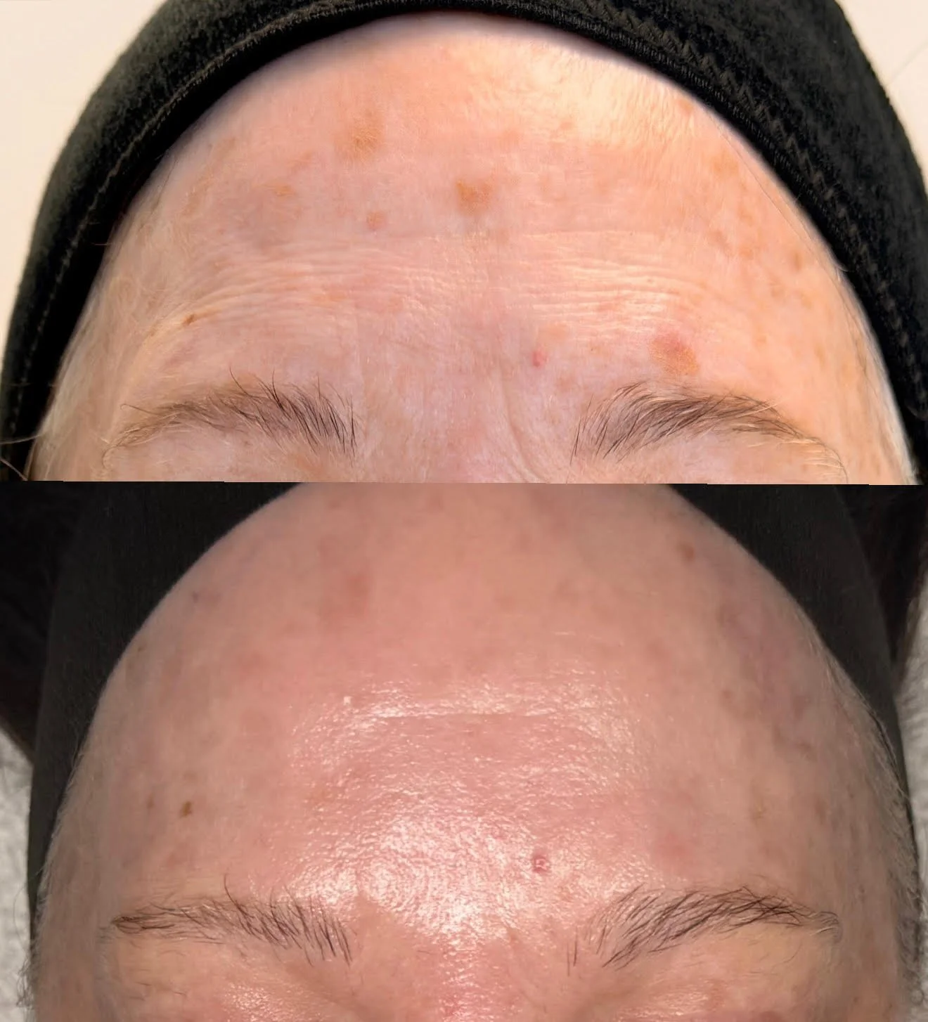 1 Session + Facial (2 weeks post CO2 Cool Peel)