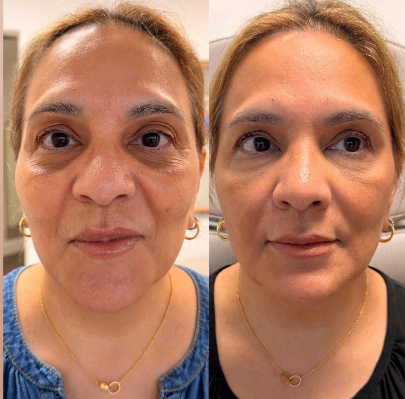 Under eye, nasolabial folds & Jawline