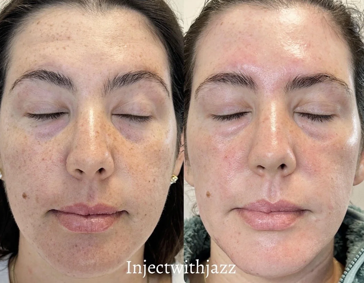 1 Session CO2 Cool Peel 
