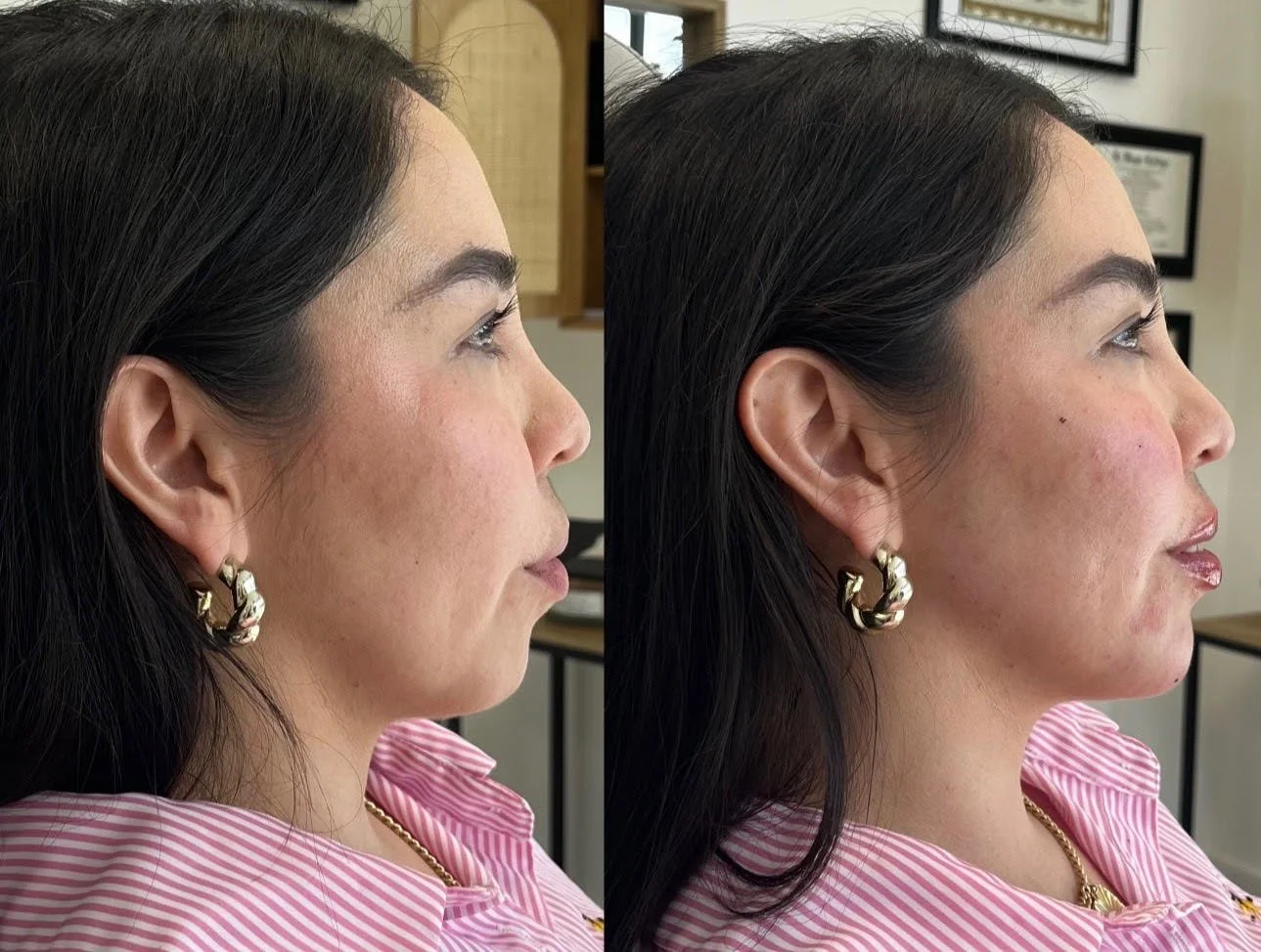 Injector: Heather Baldriche APRN  Treated Areas: Jaw, chin, cheeks & lips 