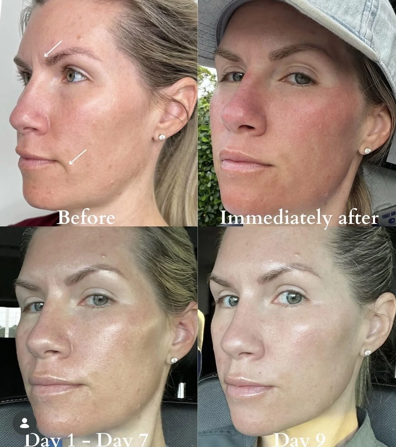 1 Session CO2 Cool with healing progression 