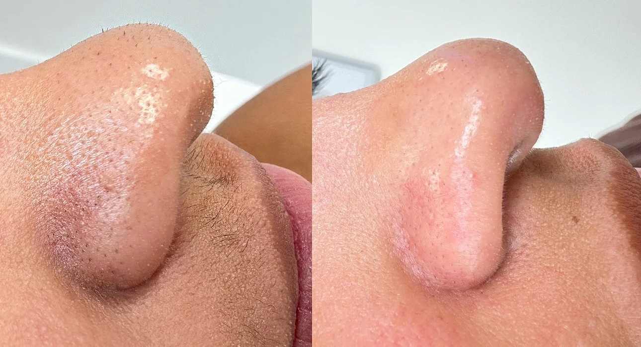 Dermaplaning Facial 