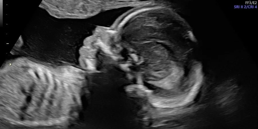 Bedrest Update: I’m Finally Off!