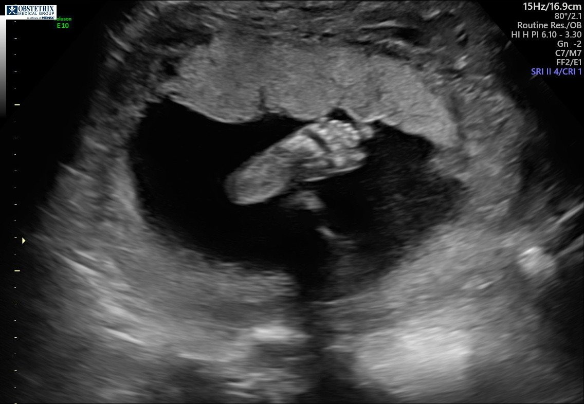 Pregnancy Update: 23 Weeks