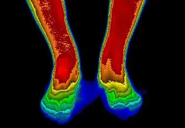 Thermal image of human feet showing temperature distribution with red indicating higher temperature and blue indicating lower temperature.