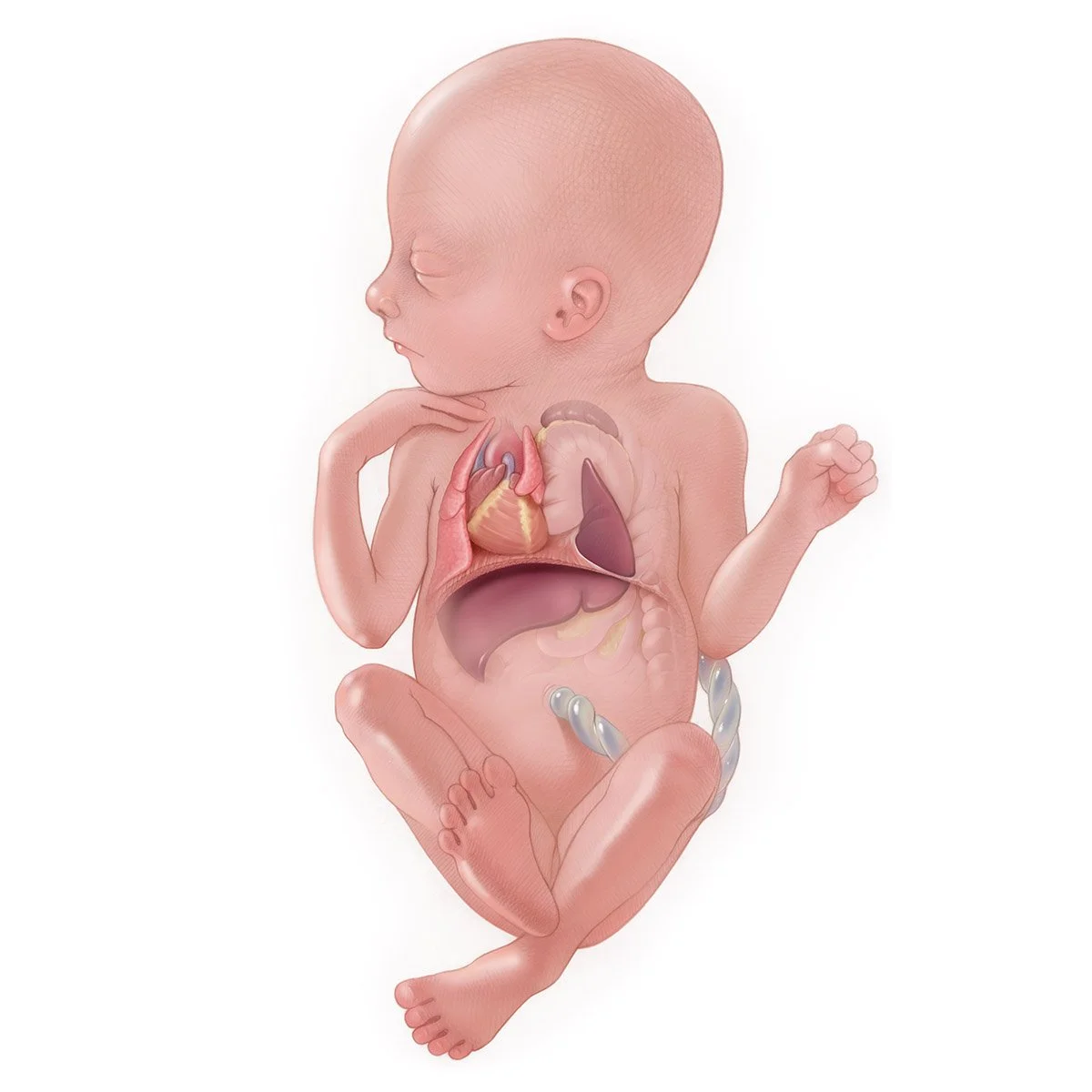 Congenital Diaphragmatic Hernia CDH