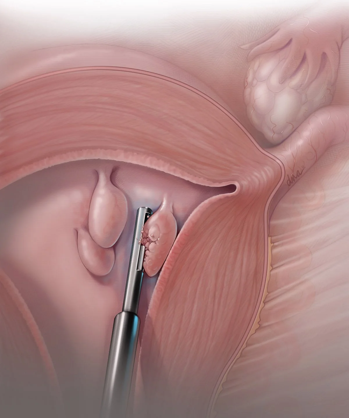 Hysteroscopic Polypectomy Procedure