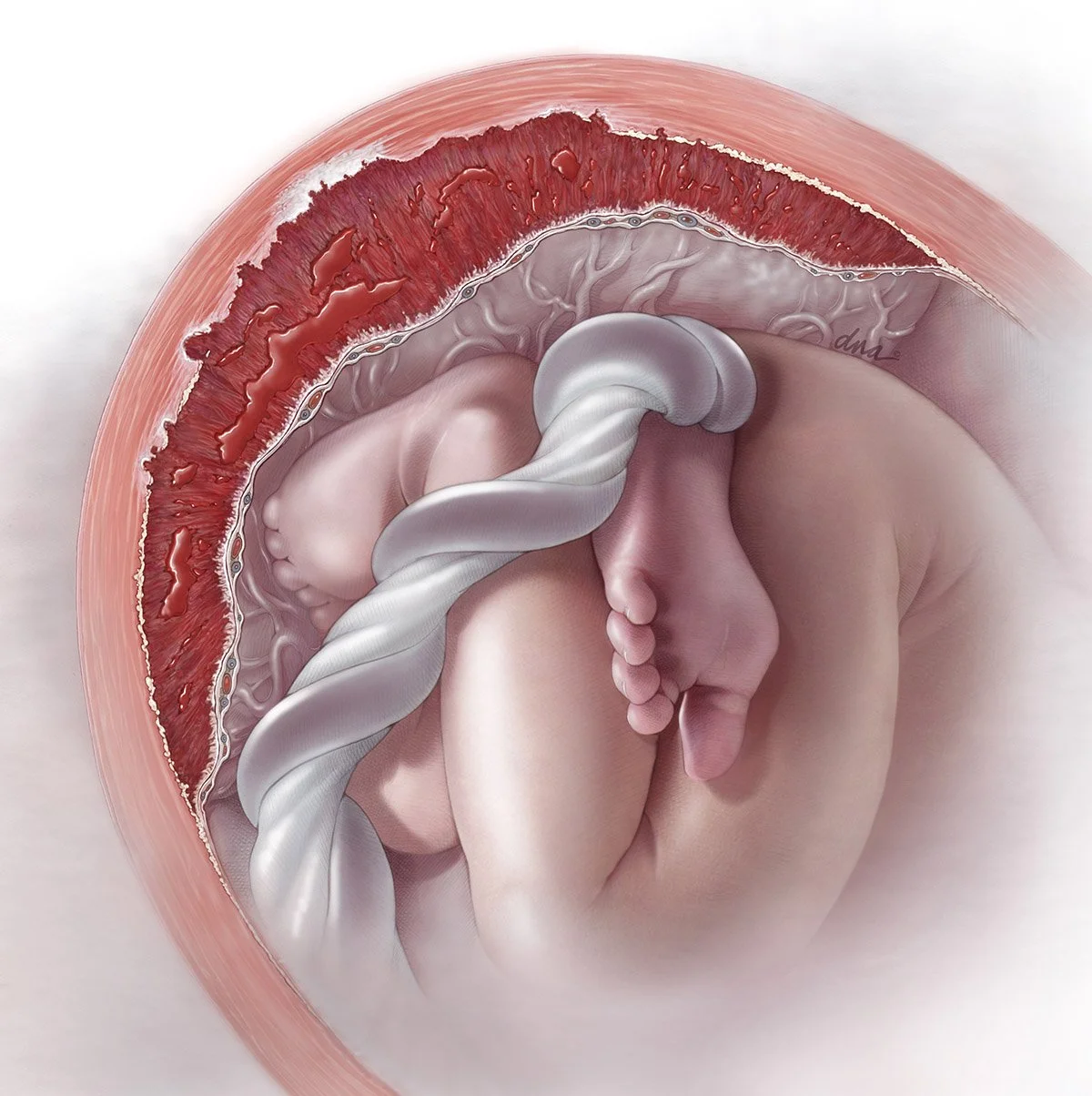 Abnormal Placentation