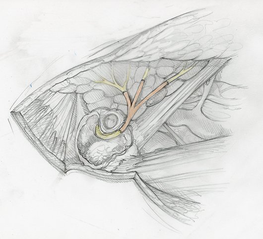 Sketch of Facial Nerve repair graft as it emerges near the Parotid Gland