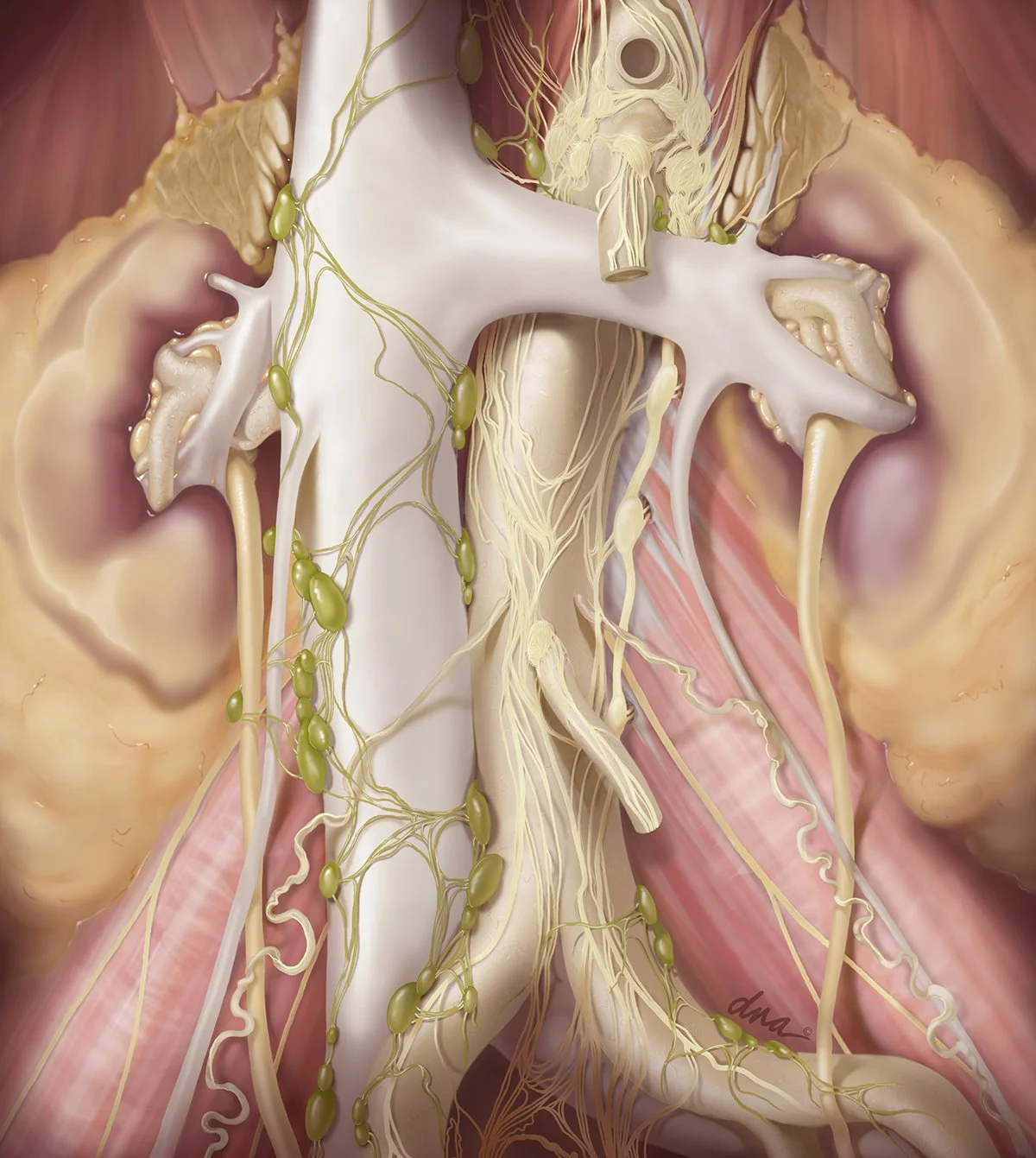 Retroperitoneal Lymph Node Dissection for treament of Testicular CAncer