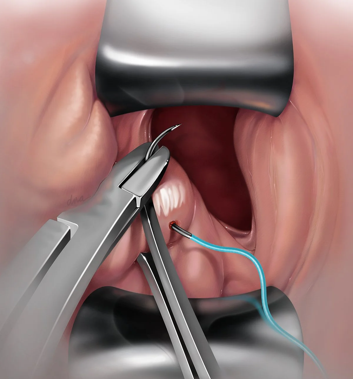 Iatrogenic Surgical Injury