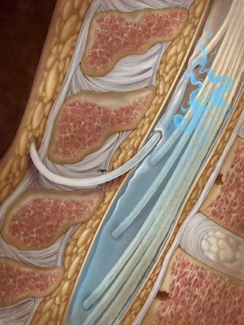Medical illustration showing intrathecal (spinal) delivery of medication for intractable pain in end of life patients