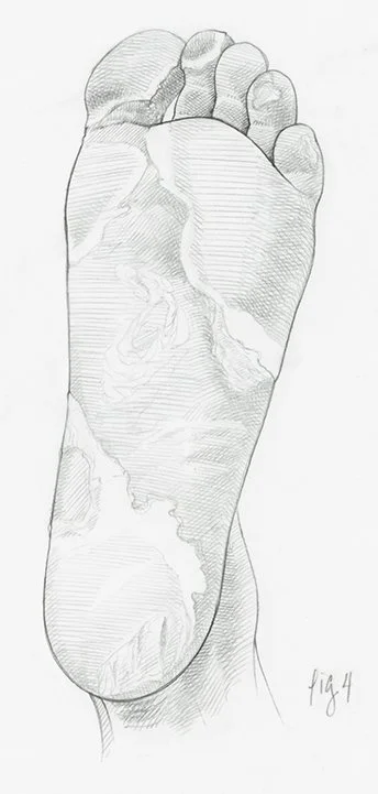 Base of Foot with Psoriasis