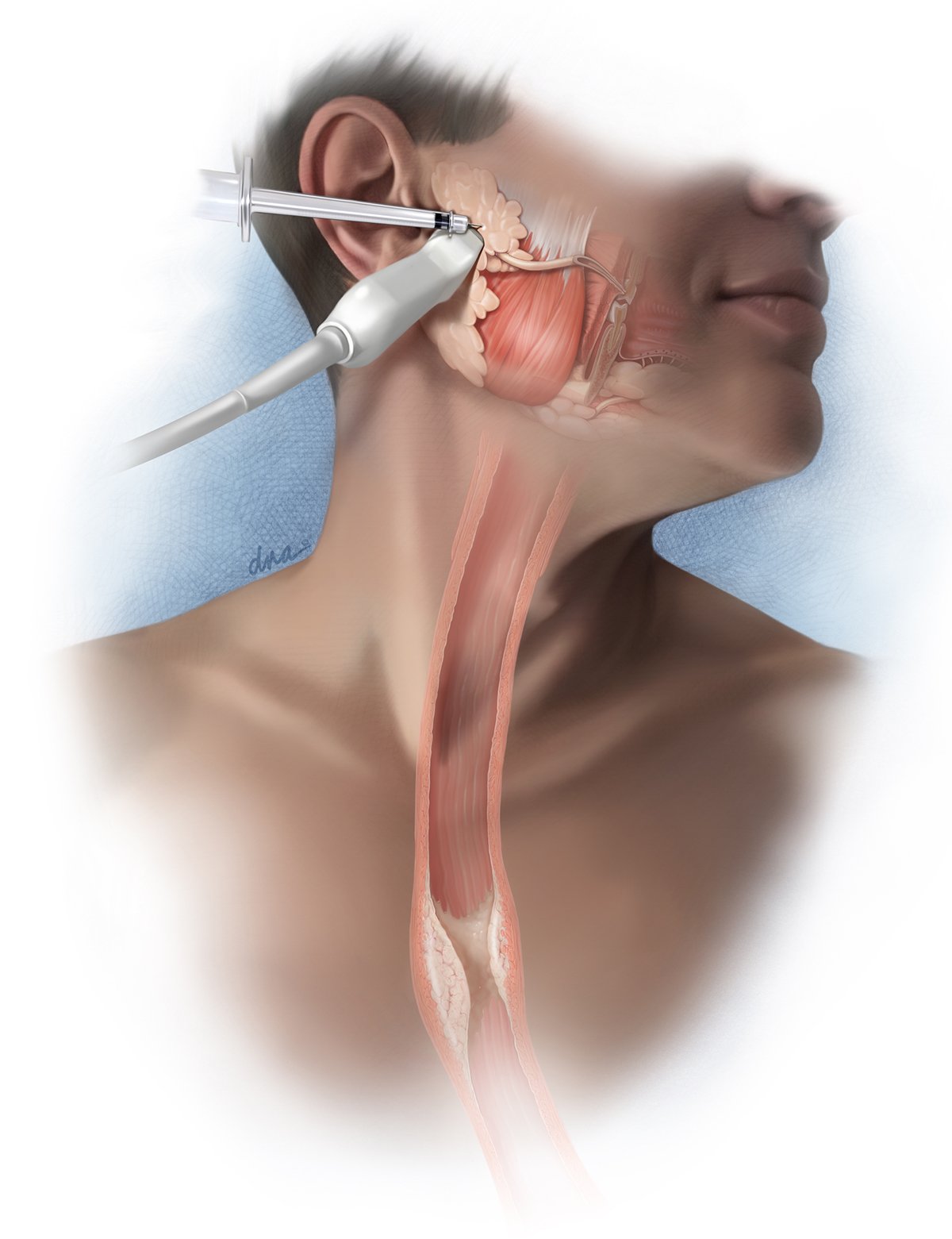 Use of Botulinum before Surgery for Esophageal Cancer 