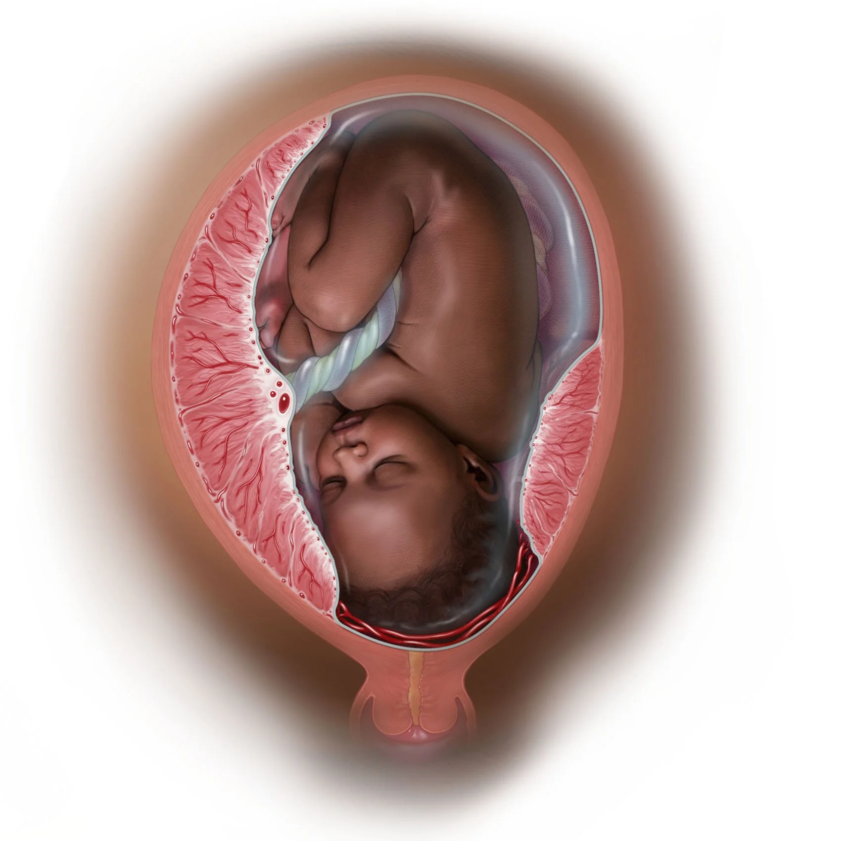 Medical illustration of Vasa Previa type 2