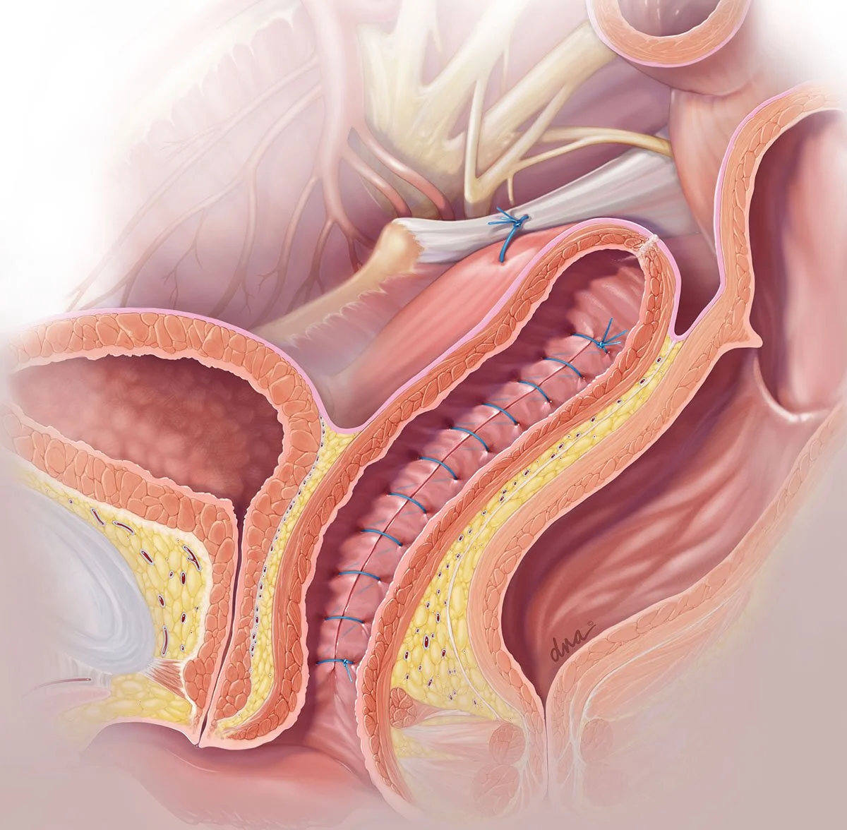Prolapse Surgery