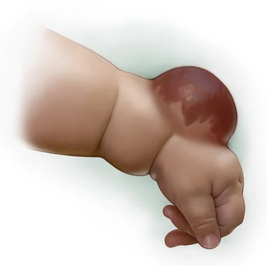 Medical Illustration of a Baby's Wrist with a solid Fibrosarcoma tumor