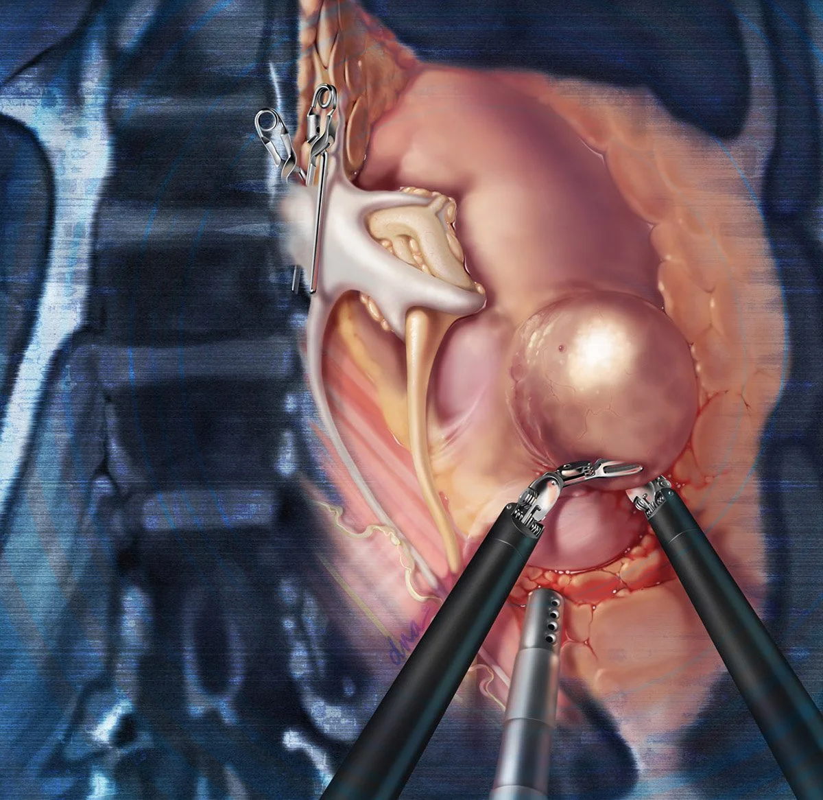 Renal Robotic Surgery Overlayed upon Imaging