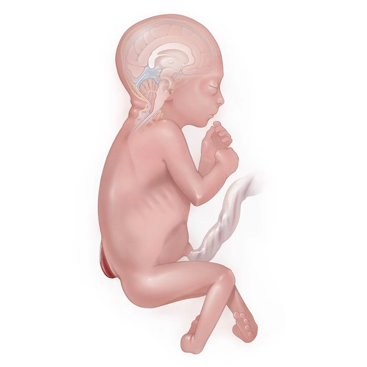 Spina Bifida Myelomeningocele 