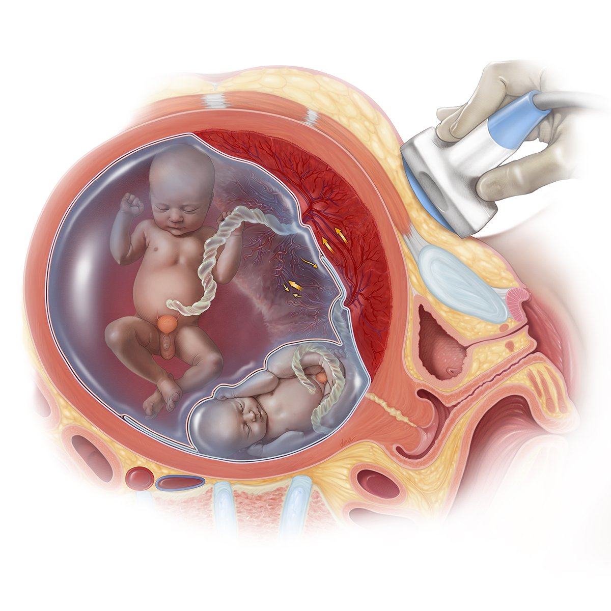 Twin to Twin Transfusion Syndrome TTTS