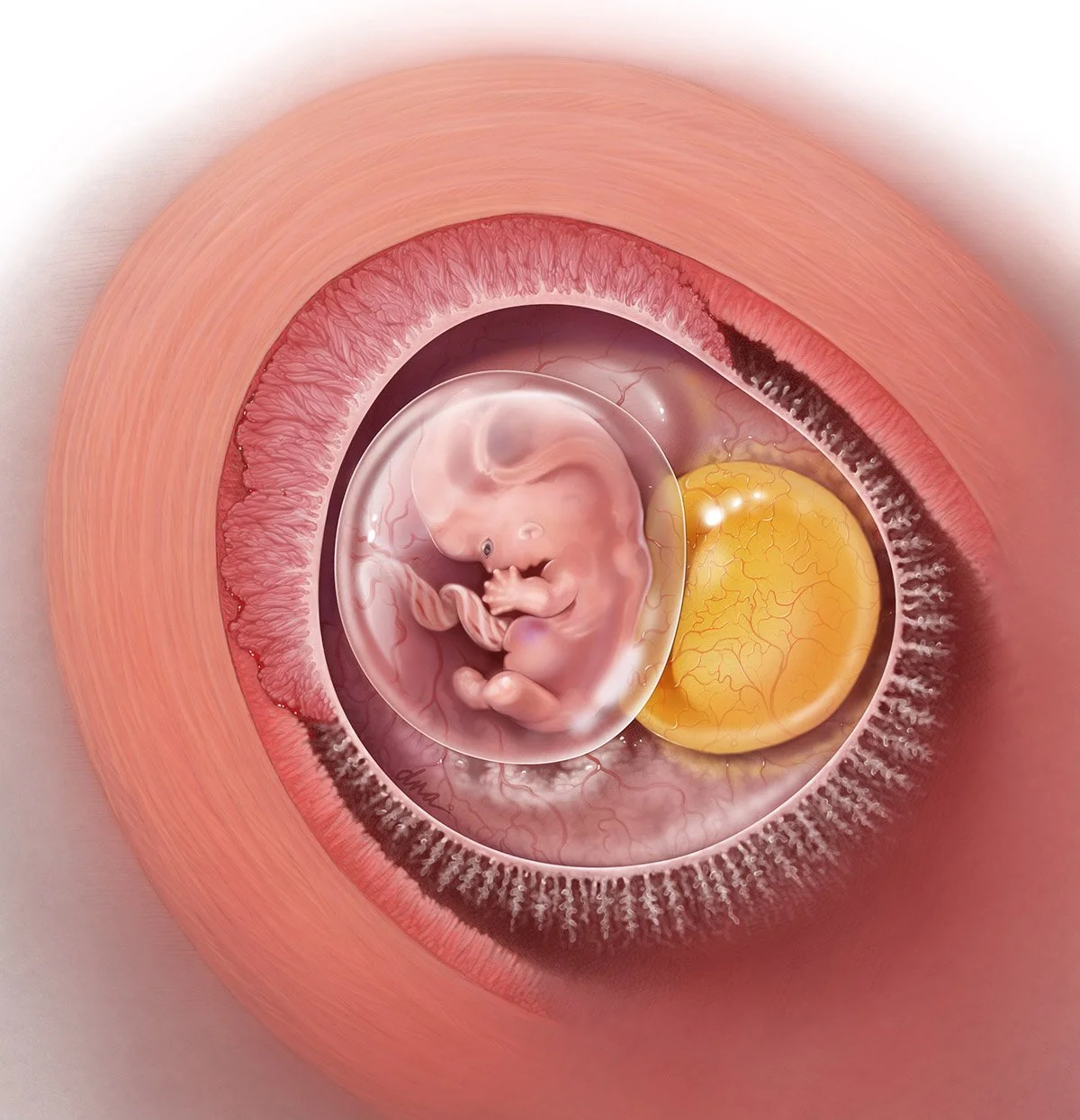 Yolk Sign in Early Pregnancy Failure