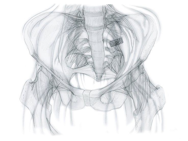 Layered sketch of Bony Pelvis with Pelvic and Sacral Nerves plexus