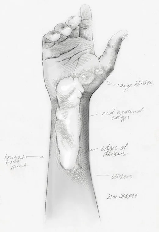 Sketch of an Arm with Second-Degree burns