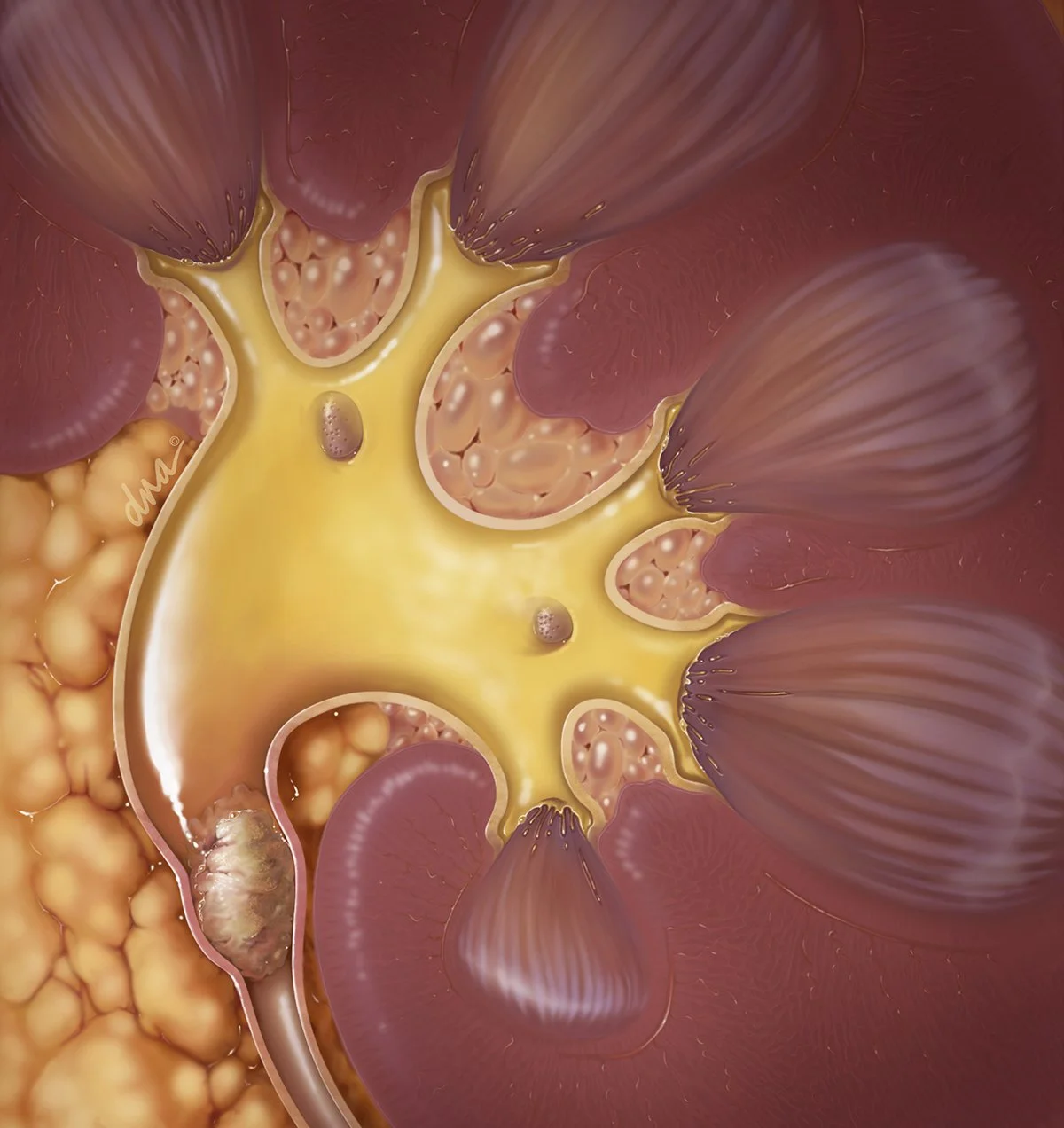 Kidney Stone