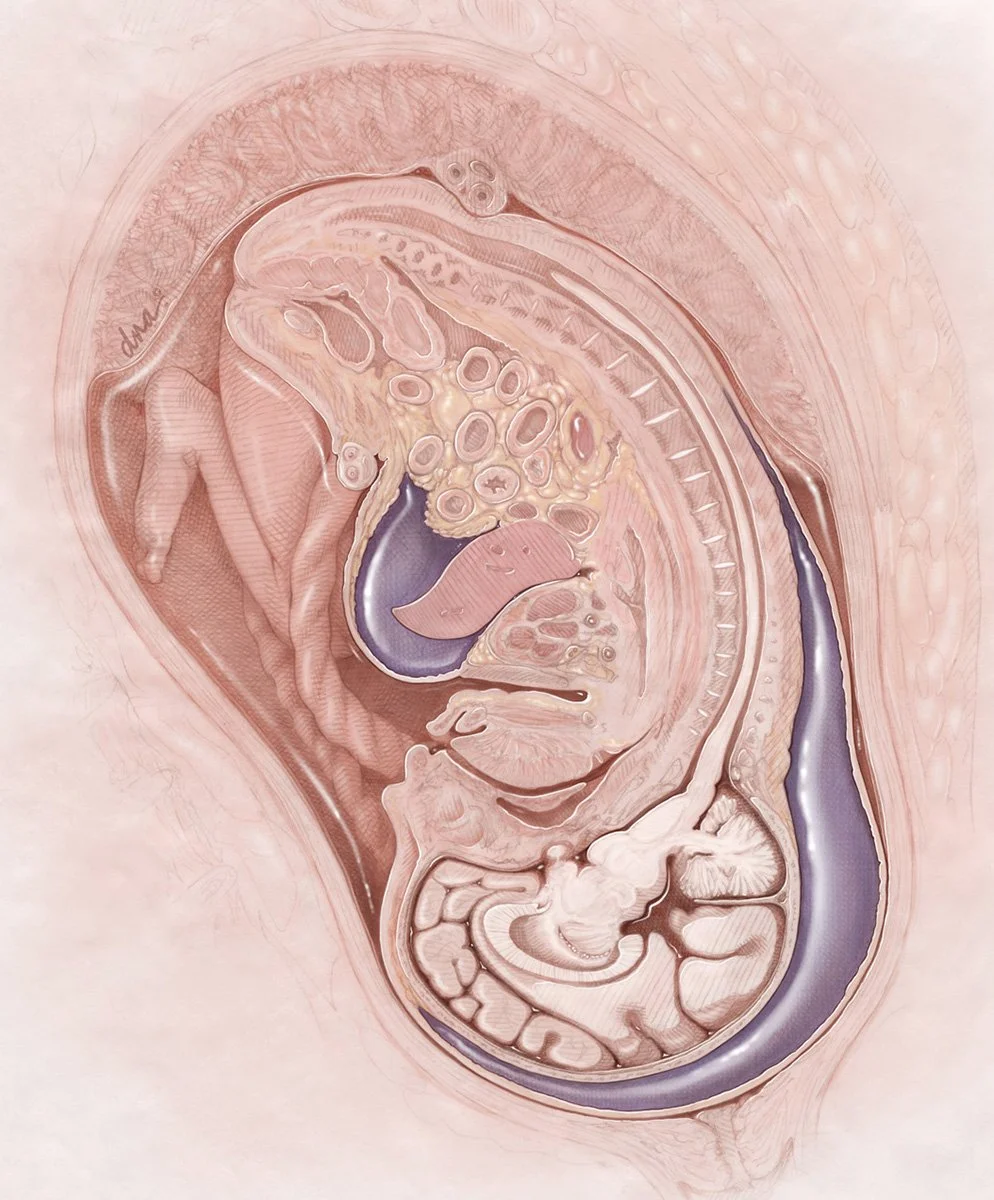 Fetal Hydrops Syndrome