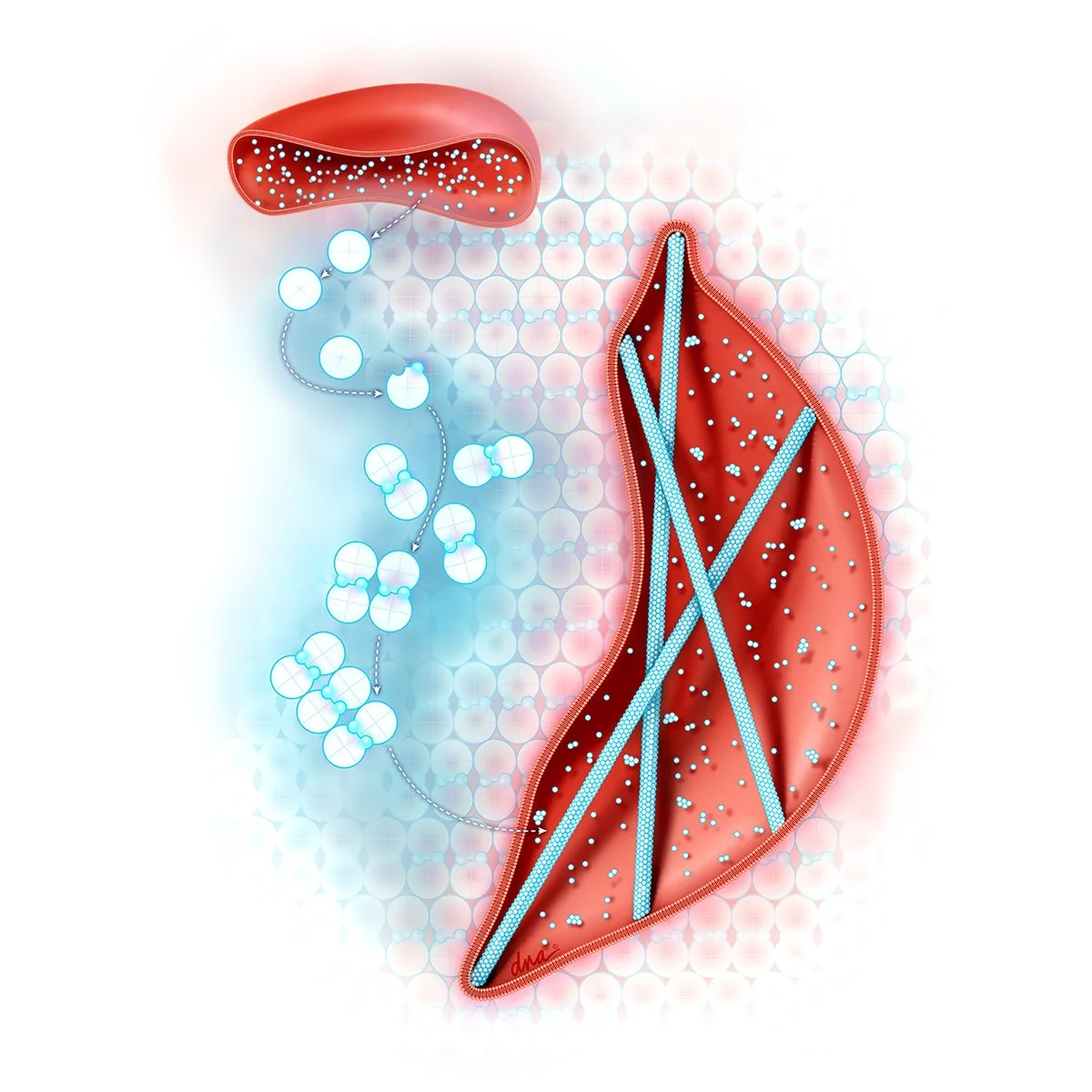 Sickle Cell Anemia Mechanism of Disease 