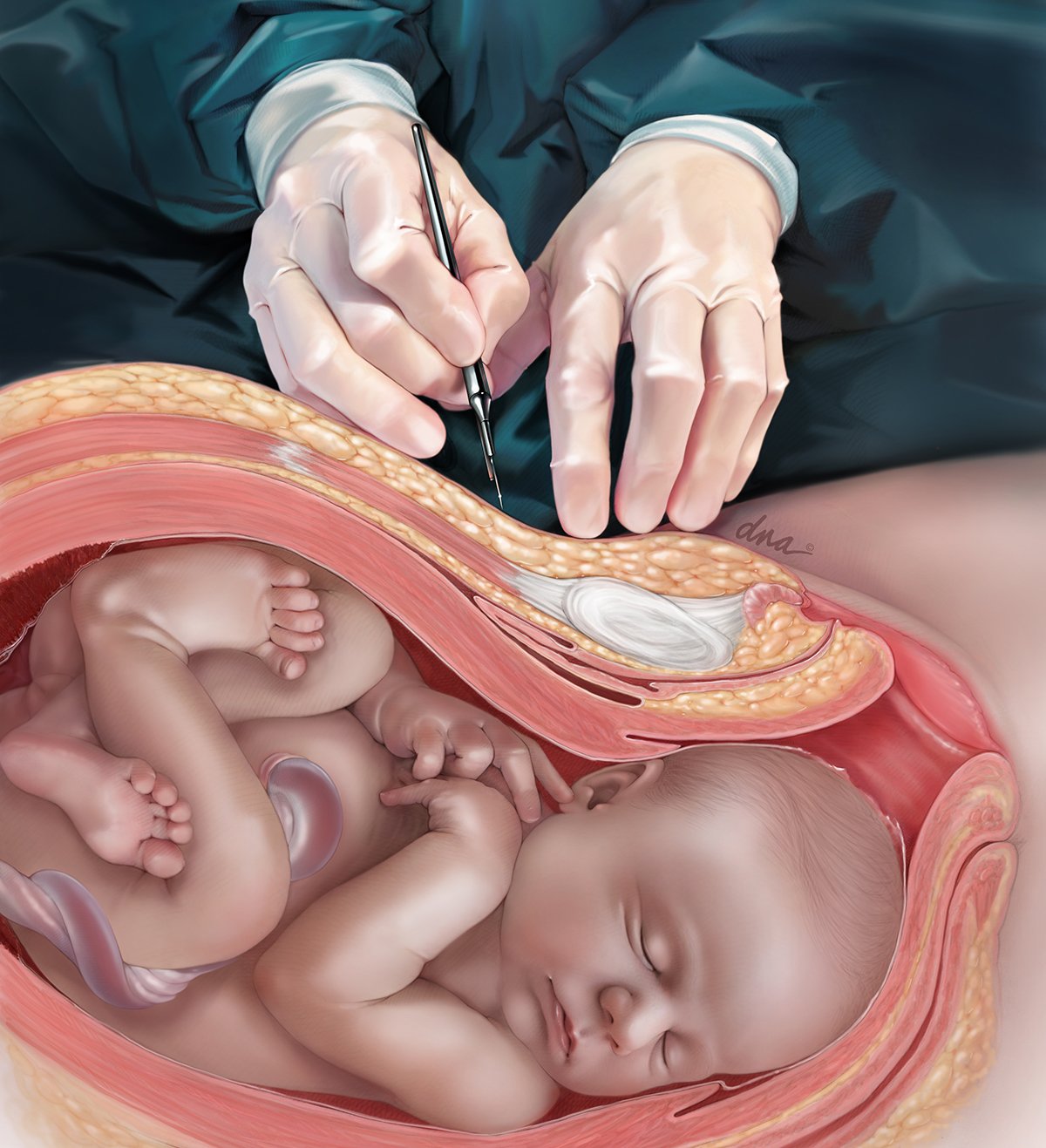 Cesarean Delivery created to accompany the article "Are We Too Quick to Cut?"