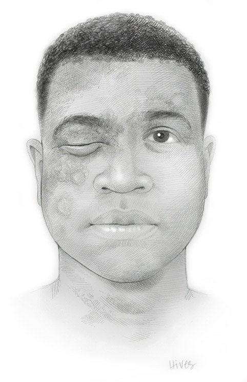 Sketch depicting hives on darker skin