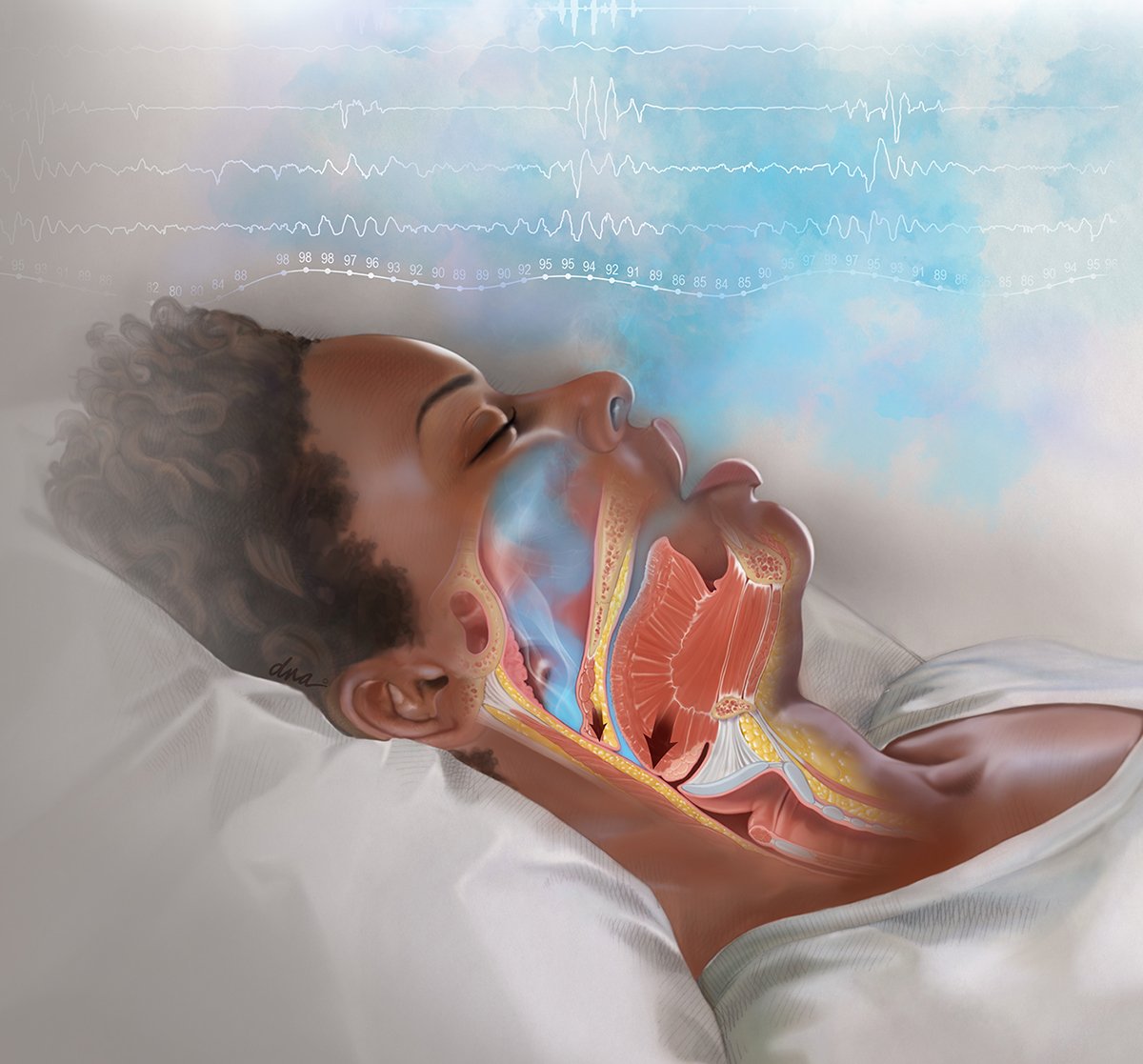 Sleep Apnea showing Blocked Airway