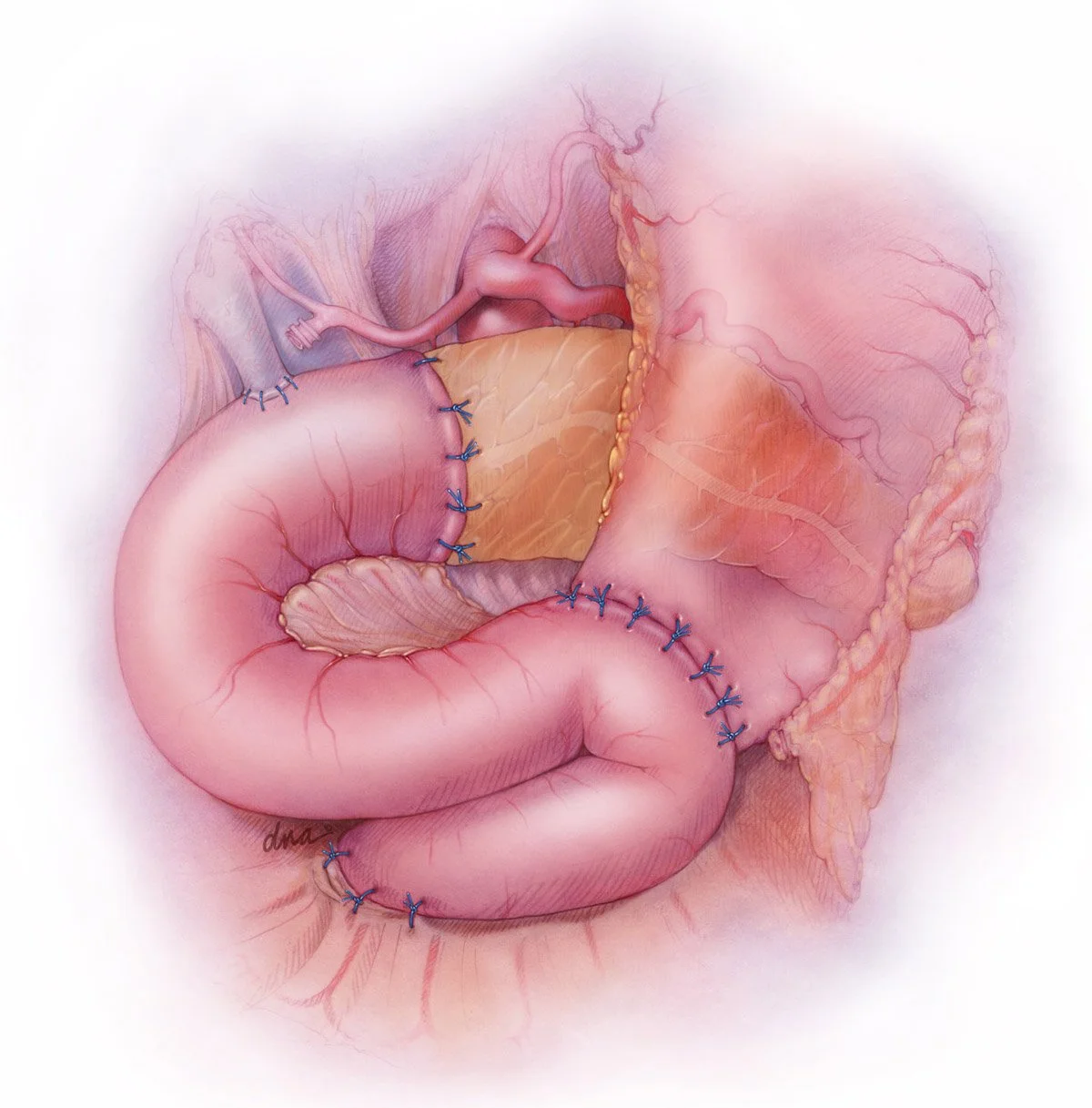 Whipple Procedure - pancreaticoduodenectomy