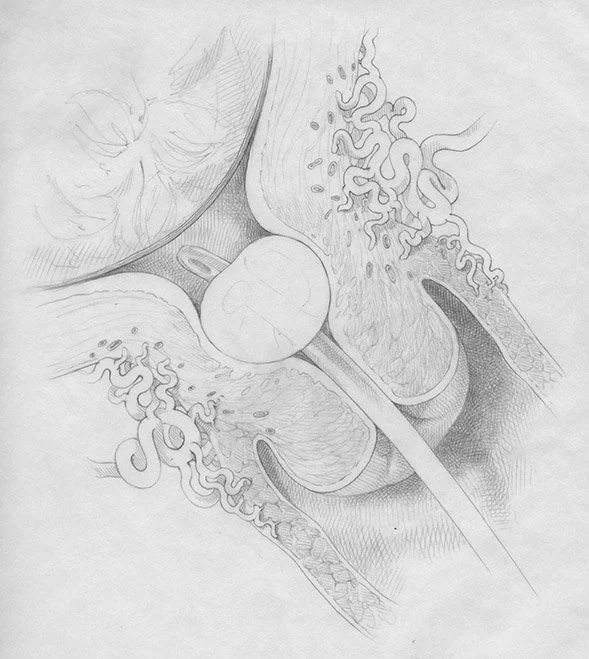 Insertion of a Foley catheter to induce labor