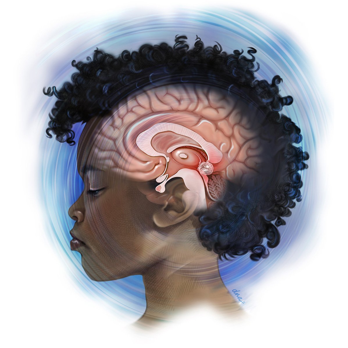 Pineoblastoma in a young child