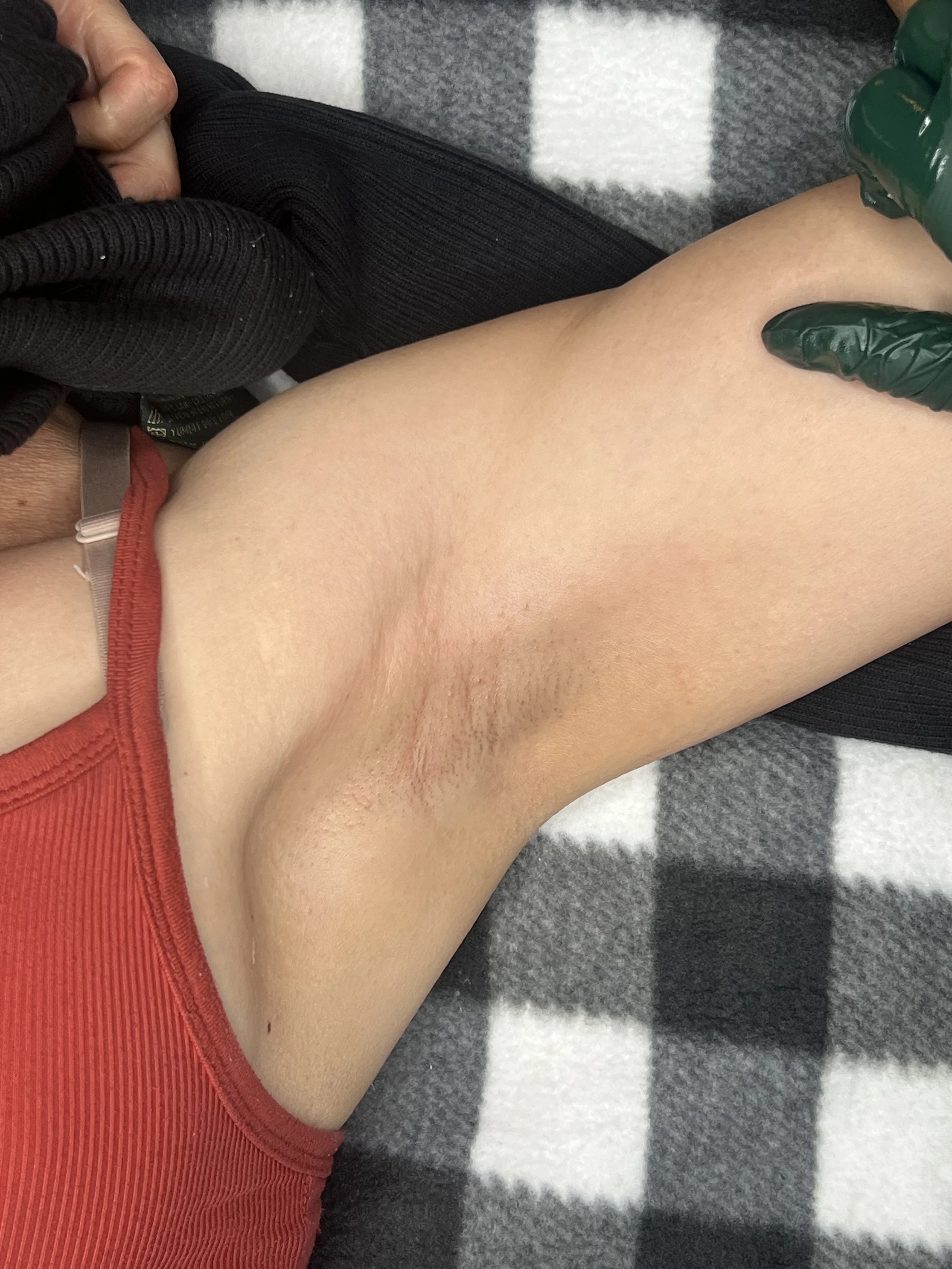 Close-up view of armpit with a small incision, partially covered by a red shirt, with a person in a black sweater holding their arm and wearing a green glove, on a grey and white checkered surface.
