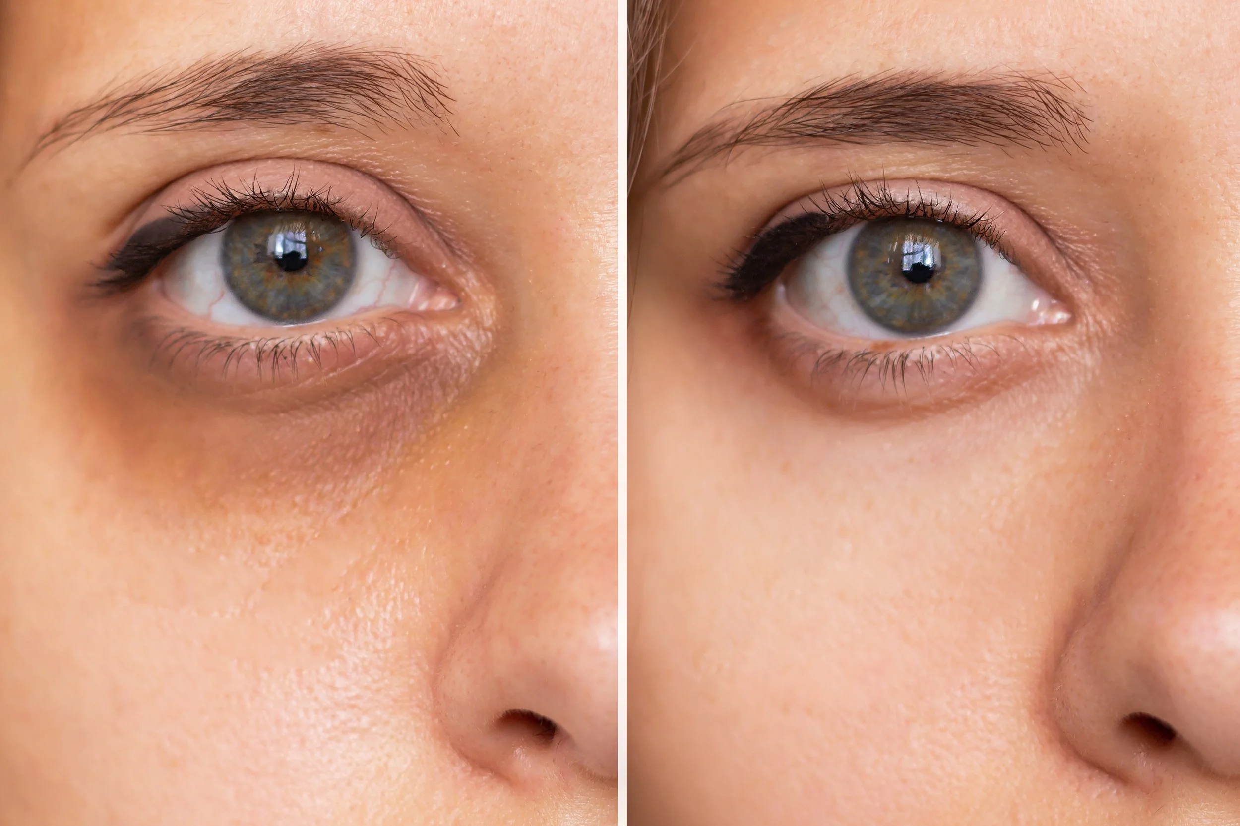 Under-Eye Filler in Bangkok: Treating Dark Circles and Hollows Without Surgery