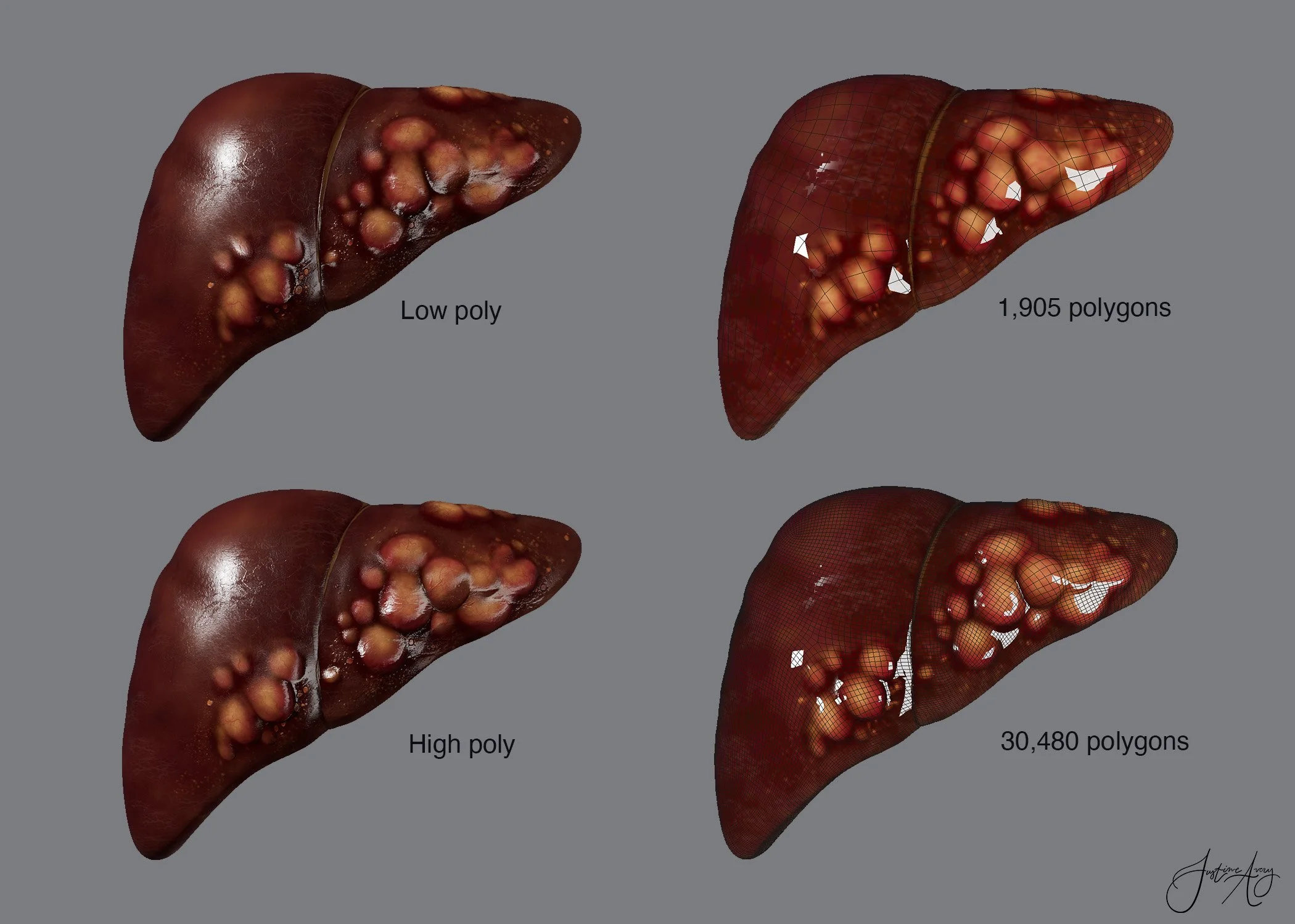   Hepatocellular Carcinoma  , Cinema4D, Adobe Substance Painter, Adobe Photoshop, 2026.

 Hi-poly vs lo-poly render using C4D and Adobe Substance Painter. Depiction on hepatocellular carcinoma. 