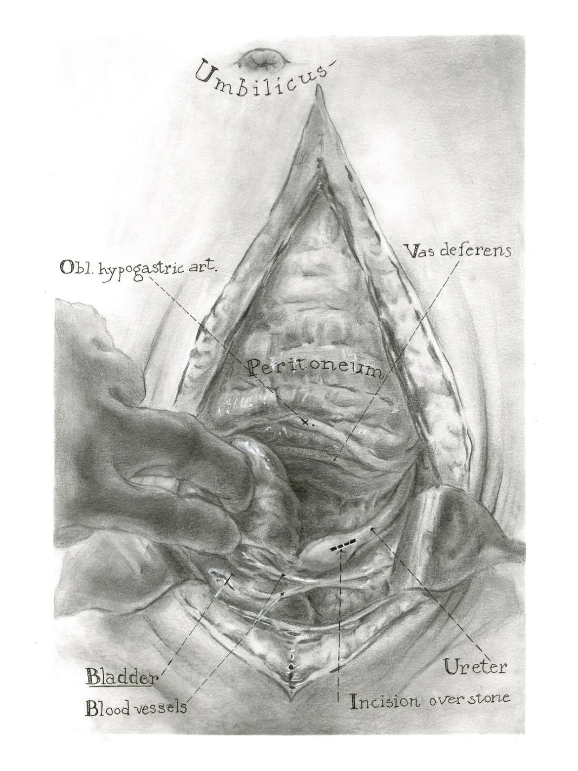   Tom Jones Master Study  , 11" x 17", Graphite on Bristol, 2025. 
 Master study of Tom Jones watercolor piece of a kidney stone removal. 