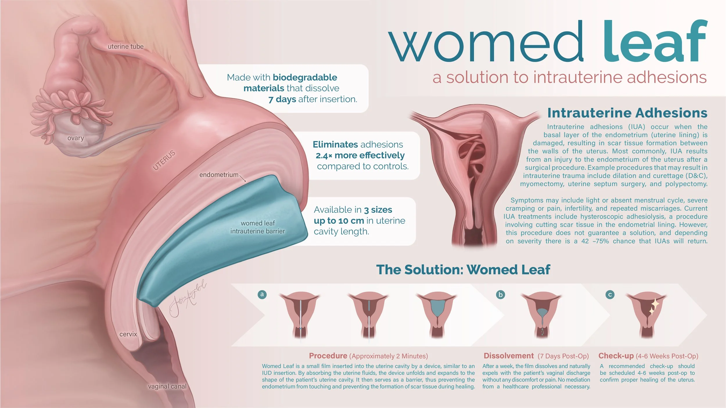   A Solution to Intrauterine Adhesions: Womed Leaf   Adobe Illustrator, Adobe Photoshop, Adobe InDesign 2026.

 This poster presents Womed Leaf, the first clinically significant medical device shown to
prevent recurrence of intrauterine adhesions (IU
