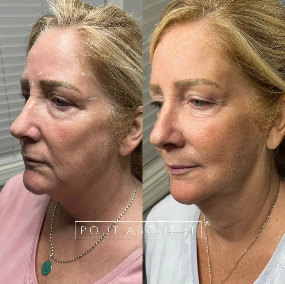 Side-by-side comparison of a woman before and after skincare or cosmetic treatment, showing improved skin texture and tone.