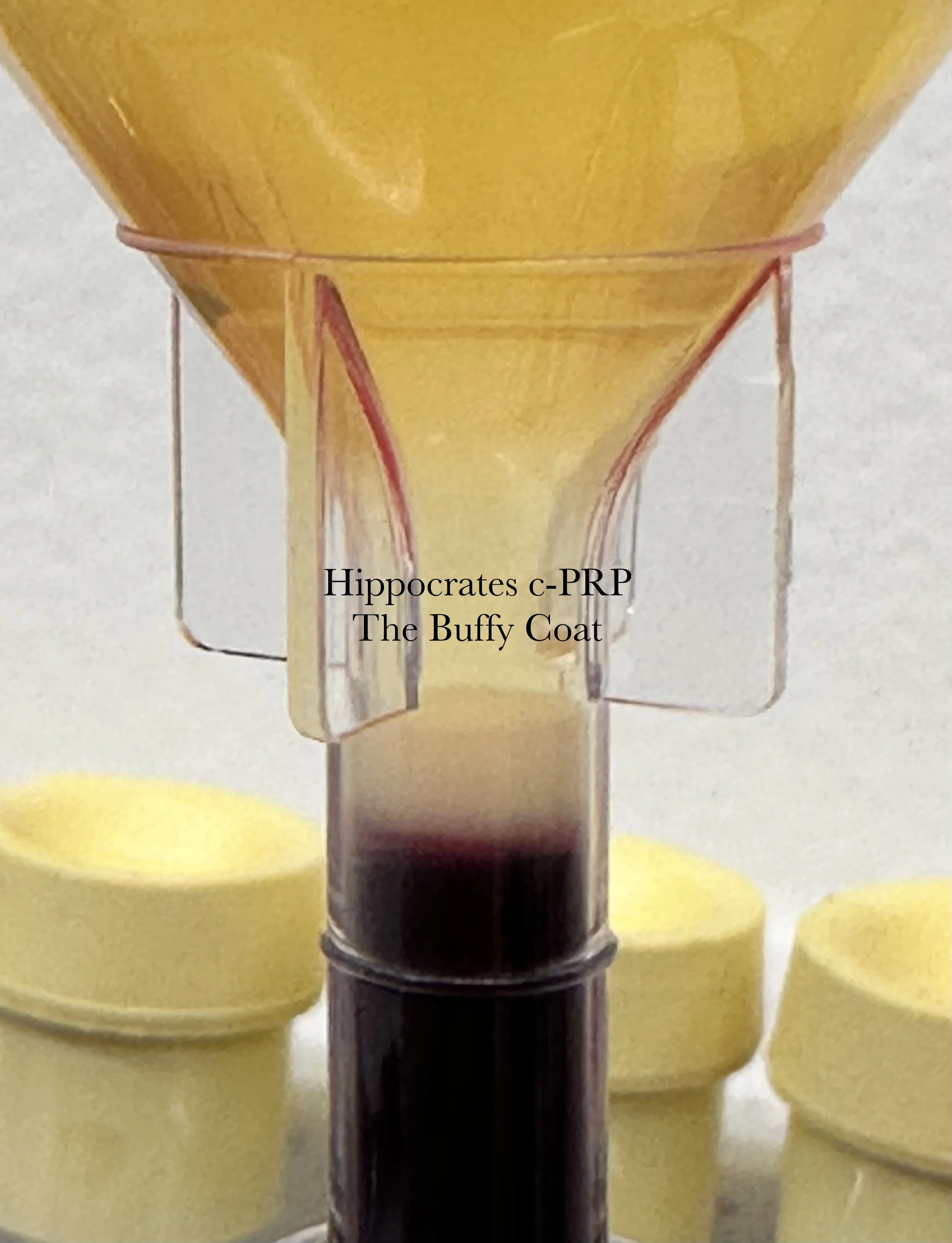 Hippocrates c-PRP Consultation