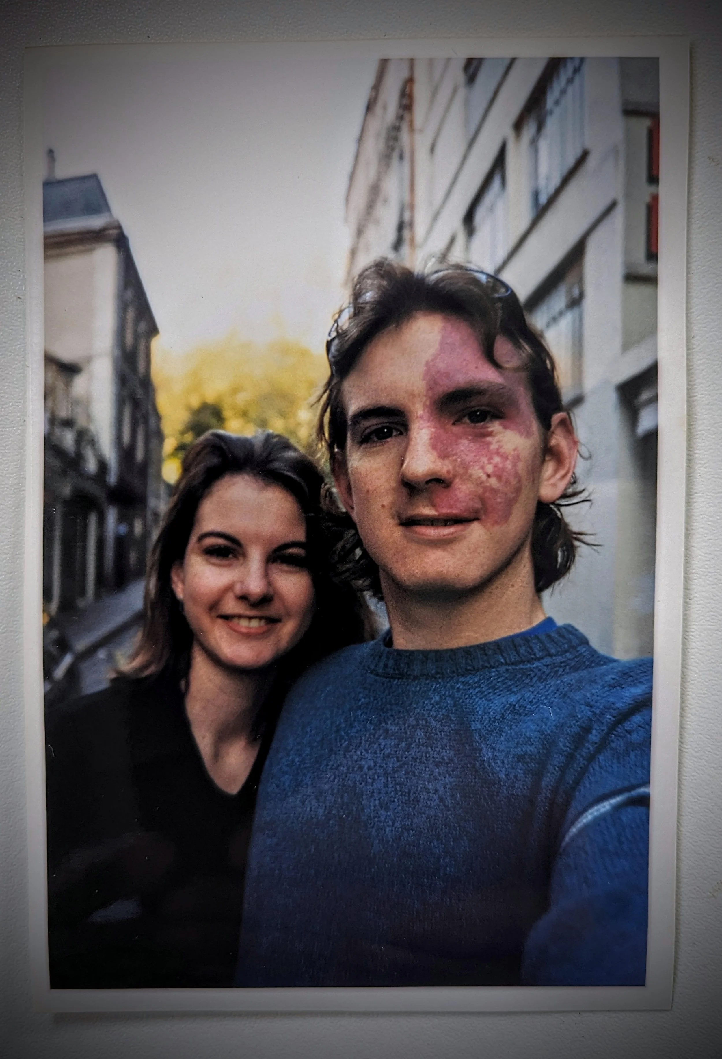 Kris Nolan with Julie in Europe in the late 1990s, during his early adult years living with a visible difference.